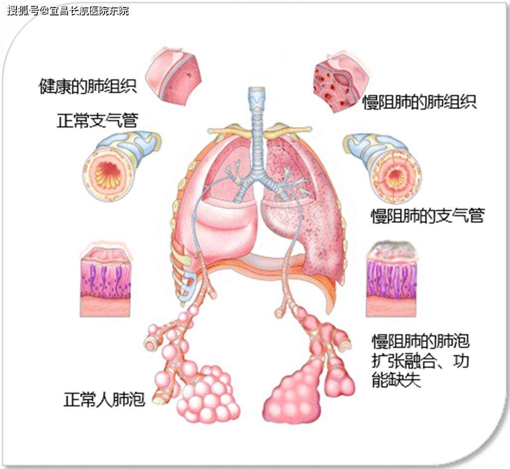 慢阻肺的症状图片