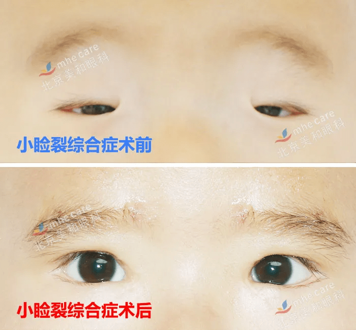 手术|五年八部曲，上睑下垂分阶段治疗的故事