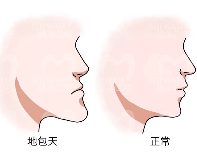 "龅牙","地包天".变美小v脸,矫牙是关键!_牙齿_脸型_下巴颏