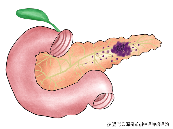 胰腺的位置在胃,肝臟,脾臟等其他器官的後面,當胰腺出現病變時,身體會