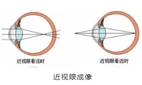 激光|近视手术全解答（番外篇）近视激光矫正术后为什么还要戴老花镜？