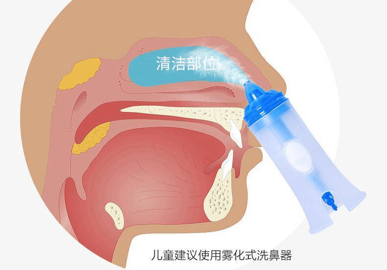 鼻腔冲洗示范图片