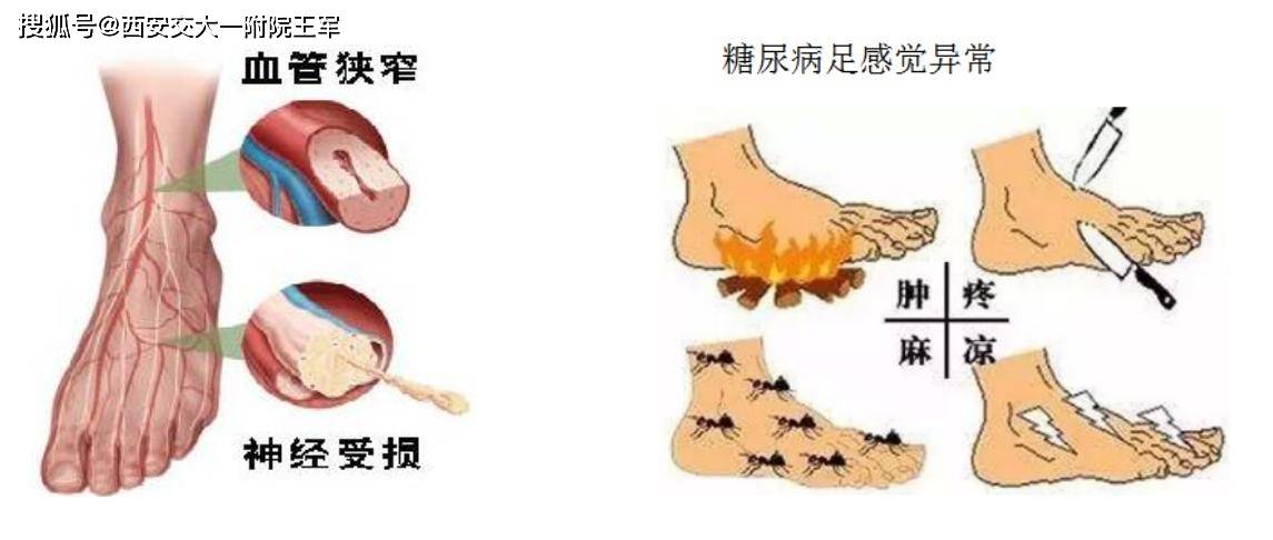 疑问|【疑问医答】哪些糖尿病患者更容易发生糖尿病足？