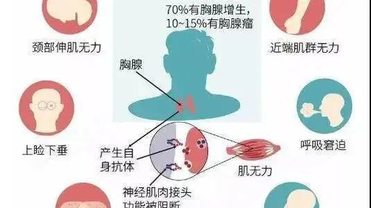 进行|重症肌无力时光复肌方多长时间有效