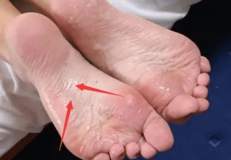 若身体这个3处"痒",体内或有"癌细胞"_脚底_肛门_疾病