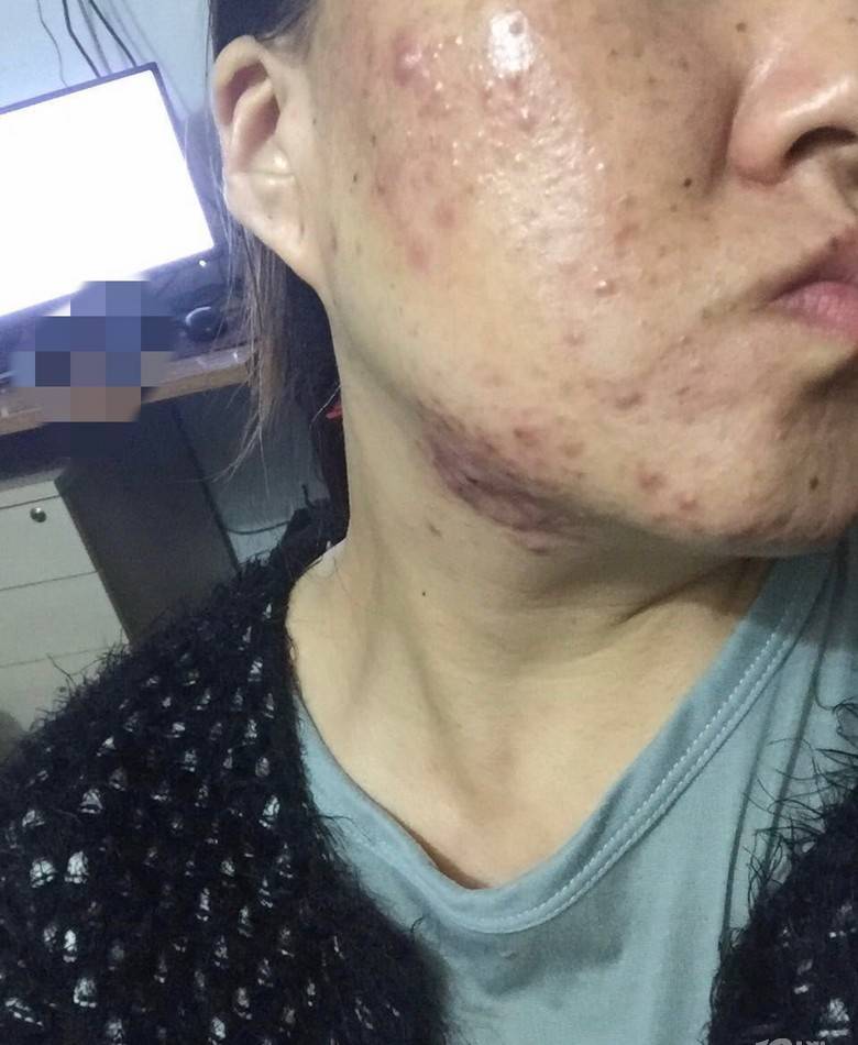 因为谭舒柳的祛痘是真的吗？谭舒柳有没有效果？