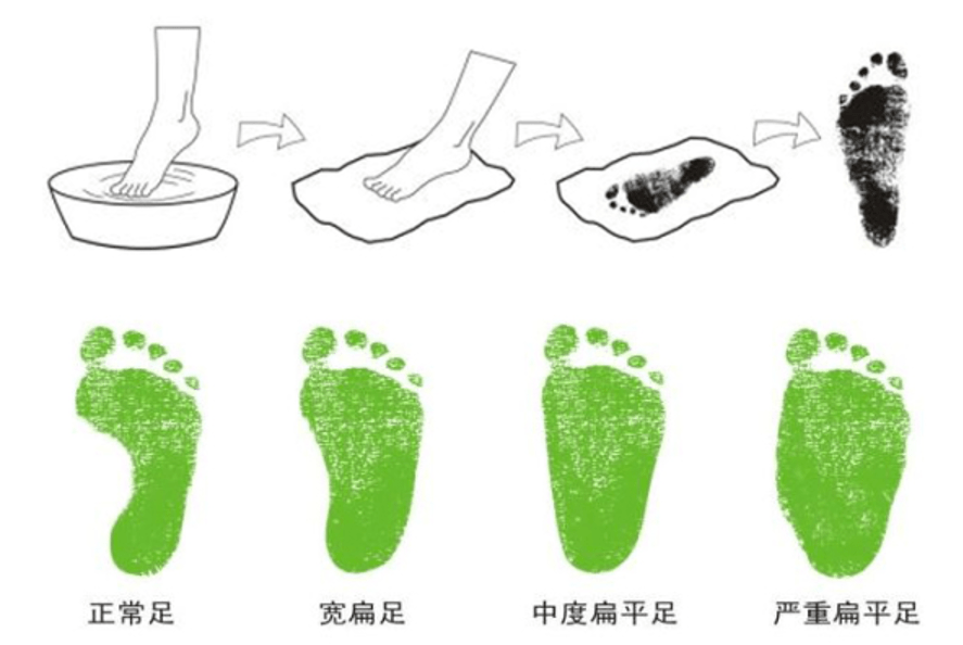 水印孩子扁平足得到积极干预，爱矫健矫正鞋值得推荐