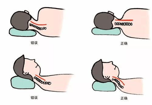 抗疫当前健康宅家当心颈椎病逼近