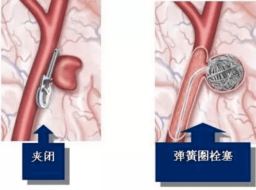 血管|头晕欲裂揪出颅内动脉瘤 医生极限“拆弹”化险为夷