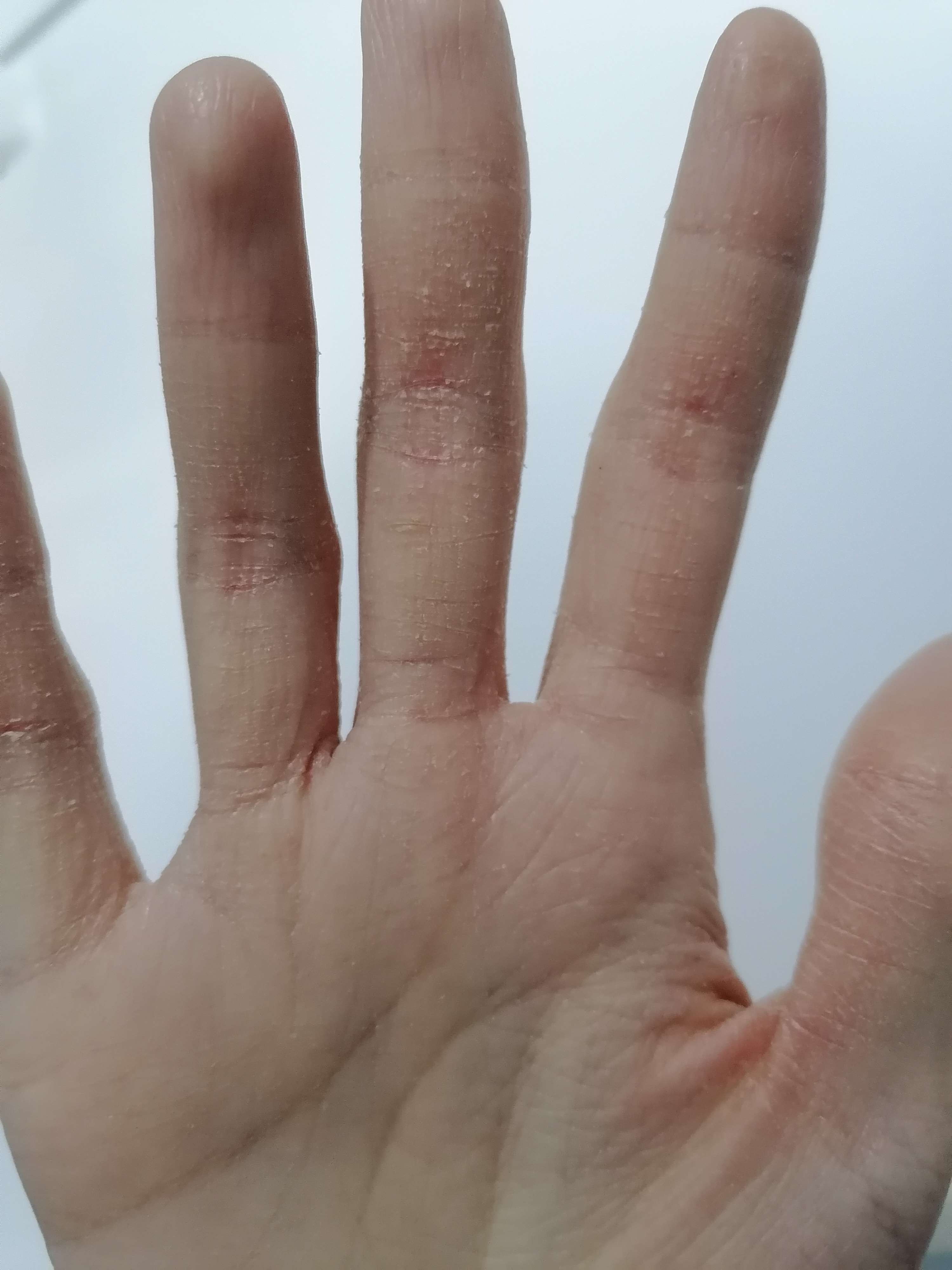 皮肤科这种情况考虑是皲裂症,最常见的是由于换季手指皮脂分泌减少