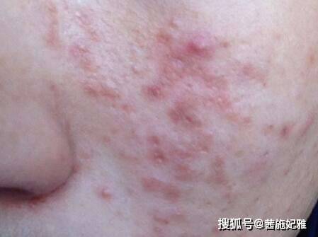 睡眠不想爆痘长斑高原红？春季皮肤维稳很重要！