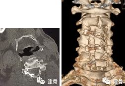 手术|头被轻轻磕一下，怎么人就瘫痪了？！本市专家：当心这种类型颈椎损伤！