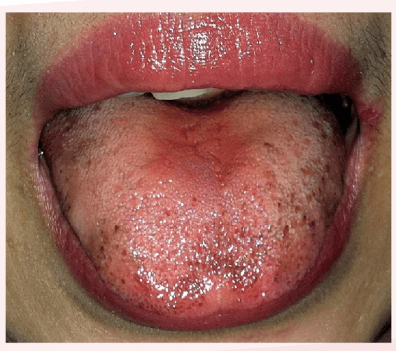 血瘀最常见到的症状就是出现暗紫舌,舌头的颜色出现了改变,有些是变成