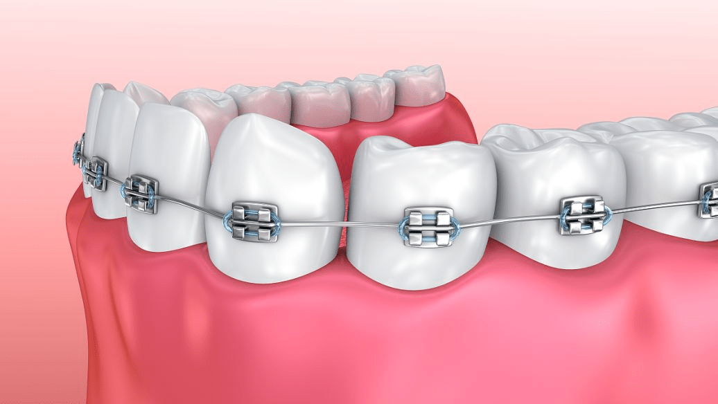 牙齒矯正會引起鬆動嗎真相是