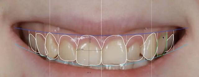 格伦菲尔吴敏慧医生正畸是如何改善微笑线的