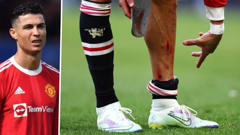 情绪失控c罗疑似怒摔球迷手机腿上血痕清晰可怖