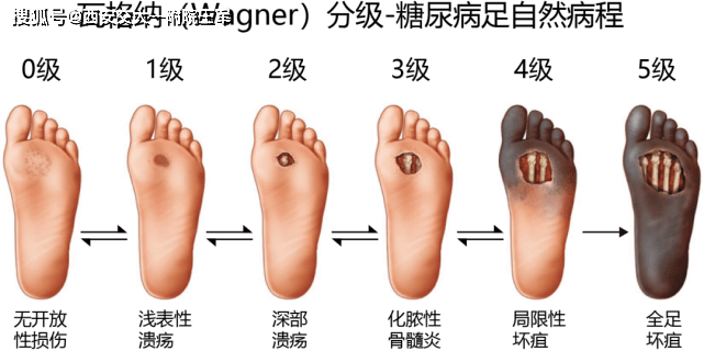 糖尿病烂脚先烂哪里图片