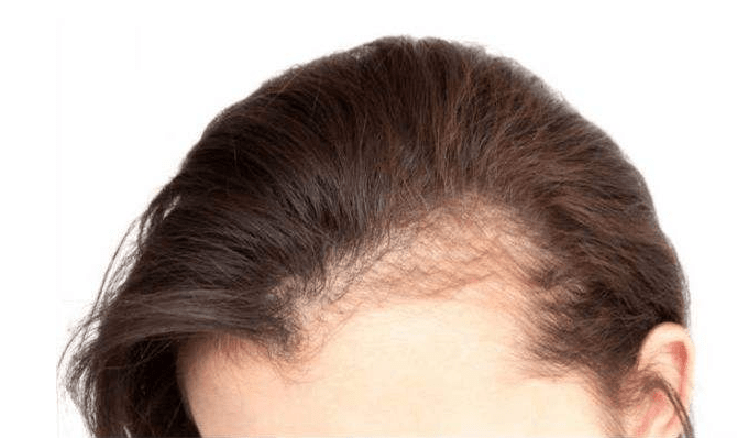 黑米3d纹发:发际线后移了,如何判断发际线是否后移?
