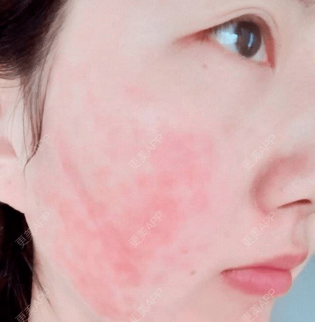 我脸上红血丝很严重我该怎么办?_肌肤_按摩_补水