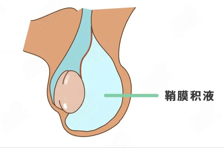 精索鞘膜積液是怎麼一回事