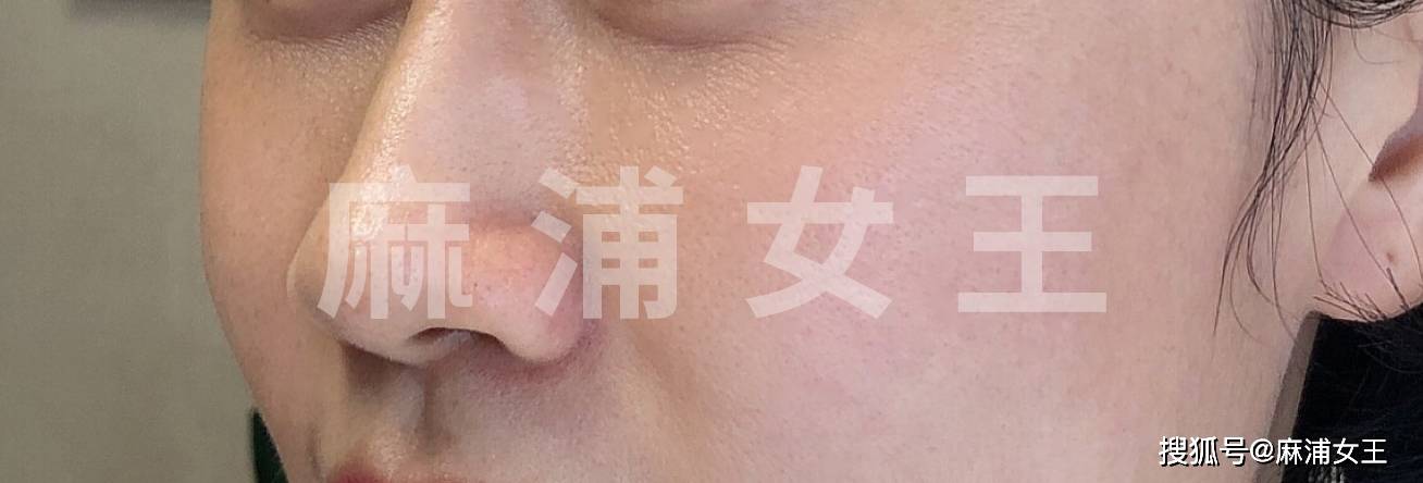 印第安纹到底能不能解决北京印第安纹剥离哪里能做