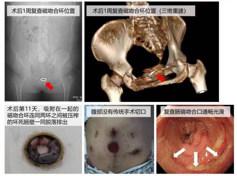 直肠环周切缘示意图图片