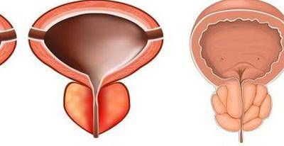 前列腺增生彩超报告单图片