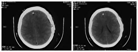 術後檢查趙天智主任介紹:顱骨骨瘤(osteoma of skull)是一種常見的