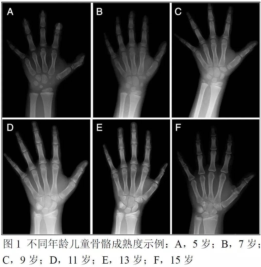 左手骨龄报告单怎么看图片