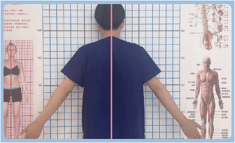 日常觀察孩子高低肩當心脊柱側彎在搞鬼