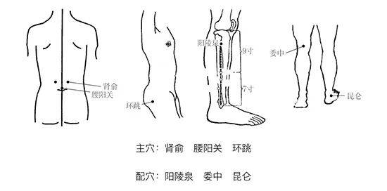 想要解决坐骨神经痛,试试穴位埋线疗法!_腰椎间盘_股骨_高跟鞋