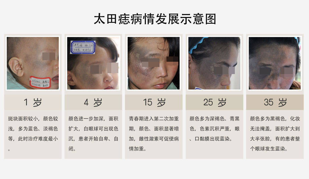 咖啡斑,黑发痣,伊藤痣等)和红色胎记( 亮红斑痣,草莓血管瘤,蜘蛛痣等)