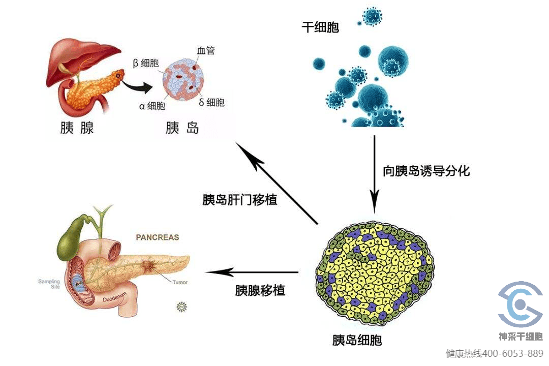 以糖尿病为例,其根源在于胰脏细胞功能减退,胰岛素分泌过少,或者对