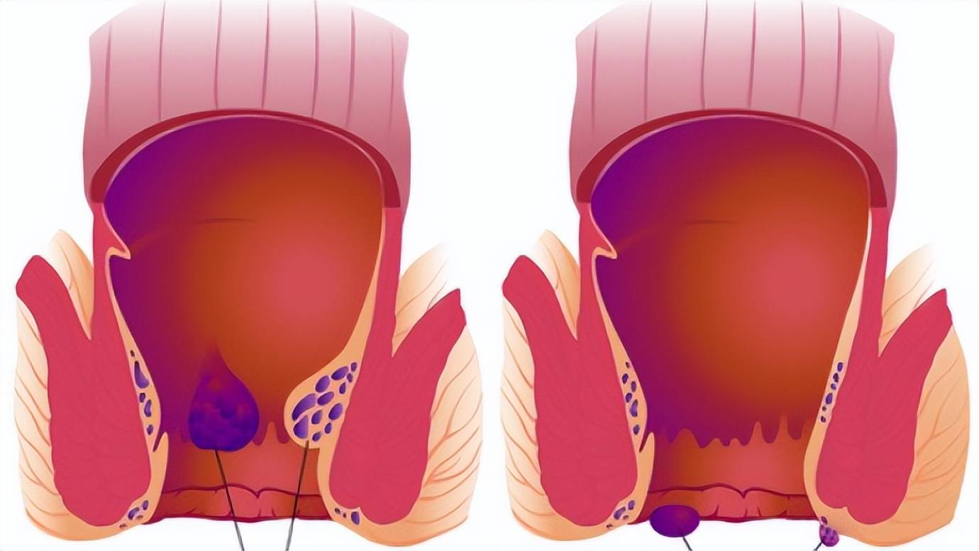 痔疮肉球该怎么缩小和消除?这几个小窍门你都知道吗?