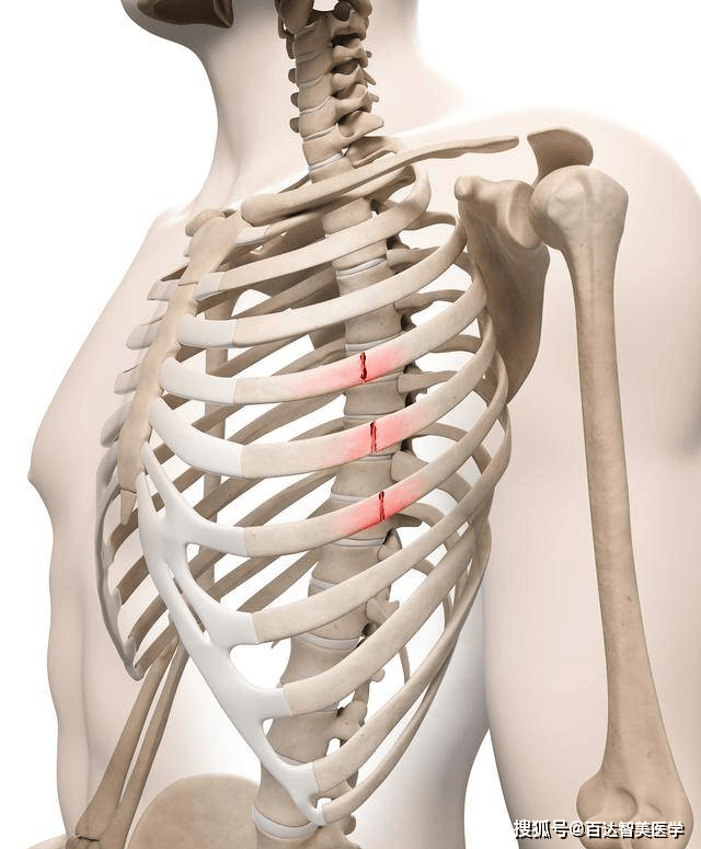 百达智美健康科普胸部肋骨骨折的固定方法肋骨外固定夹板固定带使用