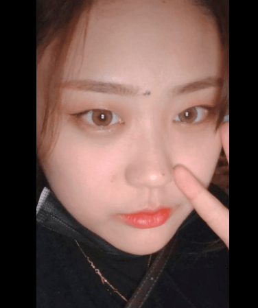 眉心的地方有赘疣(假痣),是一种非常特殊的相格,叫做"双龙抢珠".