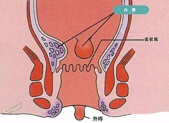在临床上痔疮依据部位可分为:外痔,内痔,混合痔,其中大部分都是内痔.