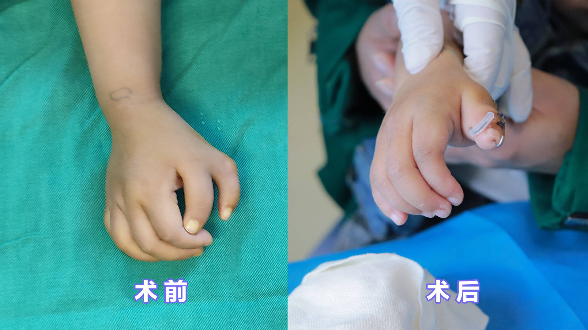 大拇指整形手术后图片图片