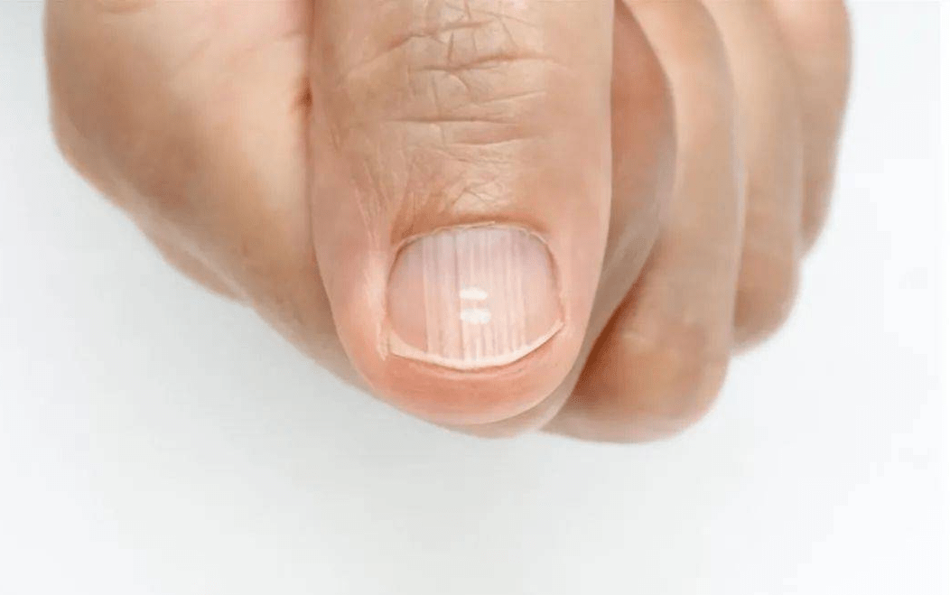 所以当人体的血液中的血红蛋白含量正常时,手指上的指甲盖就会呈现出