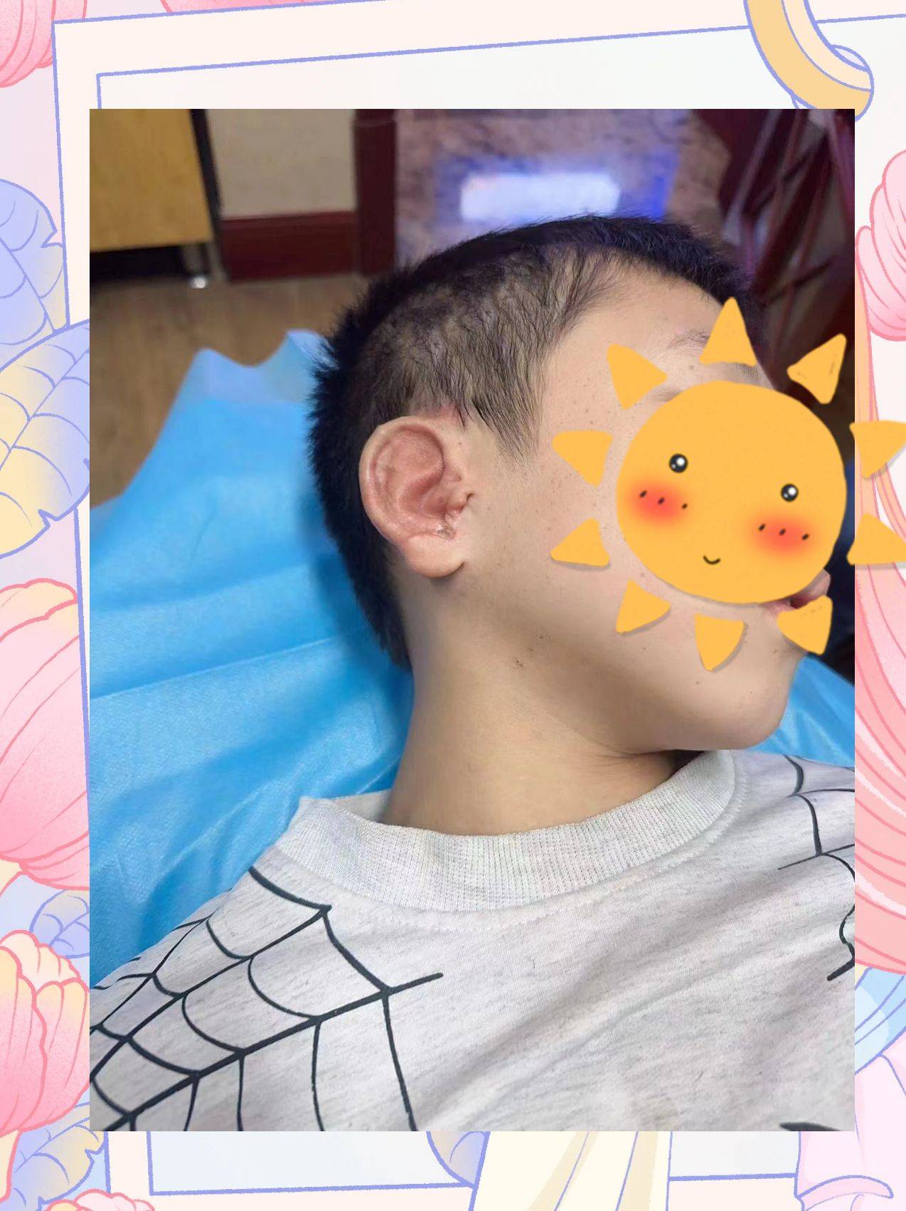 郭志华-孩子治疗耳廓整形手术五条重要的条件_耳朵_su-por_畸形