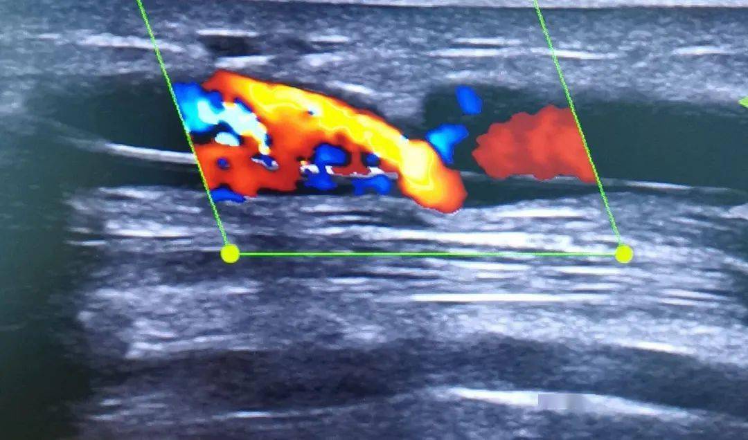 我院肾病科成功开展动静脉内瘘球囊扩张术