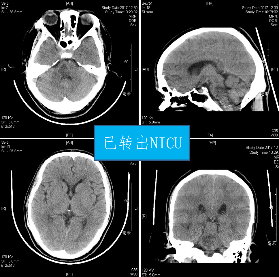 ecche 課程 | 高血壓腦幹出血的治療理念探索與臨床實踐(附2個實戰