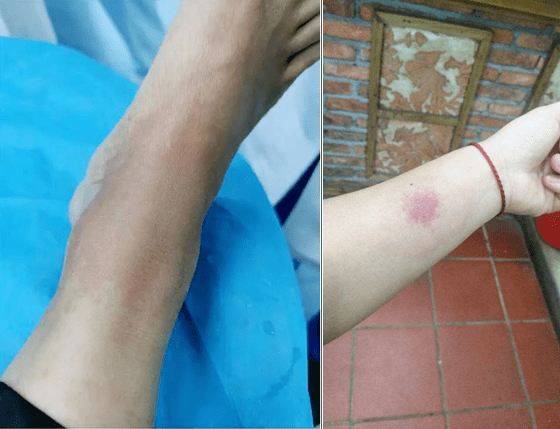 可怕温州大爷被蚂蚁咬了几口突然呼浑身发痒头晕目眩差点没命