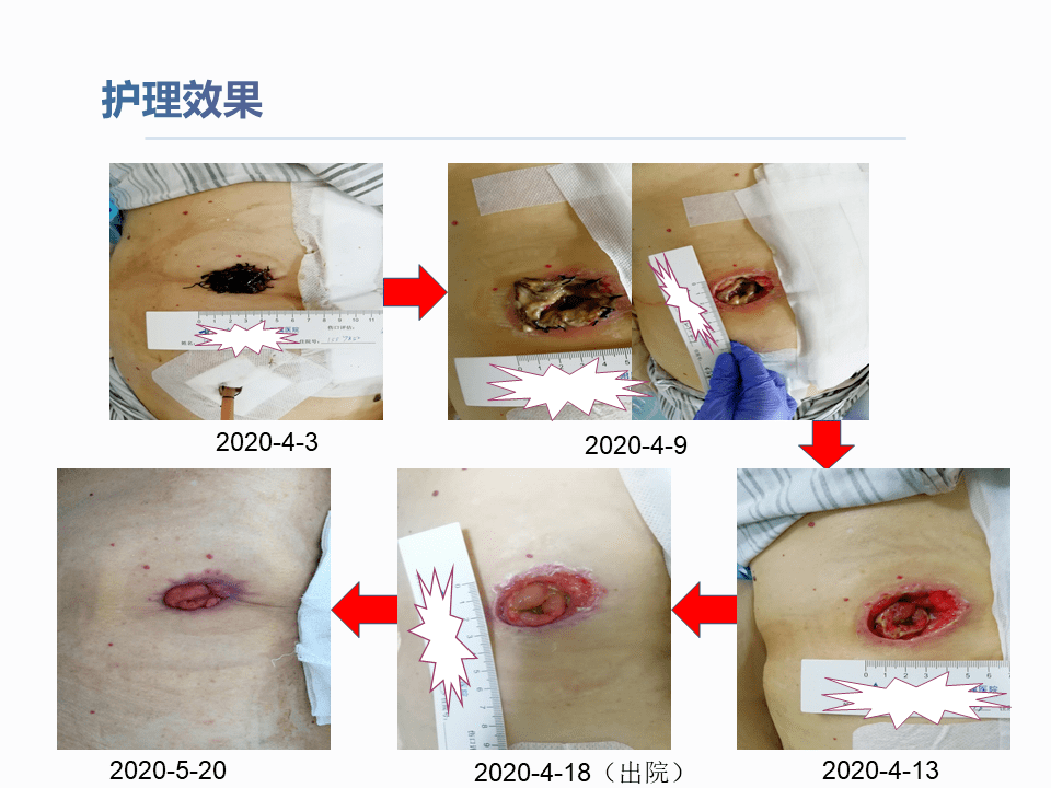 大肠造瘘术后图片图片