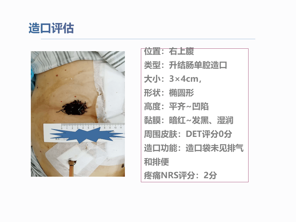 一例結腸癌術後腸造口缺血壞死護理查房