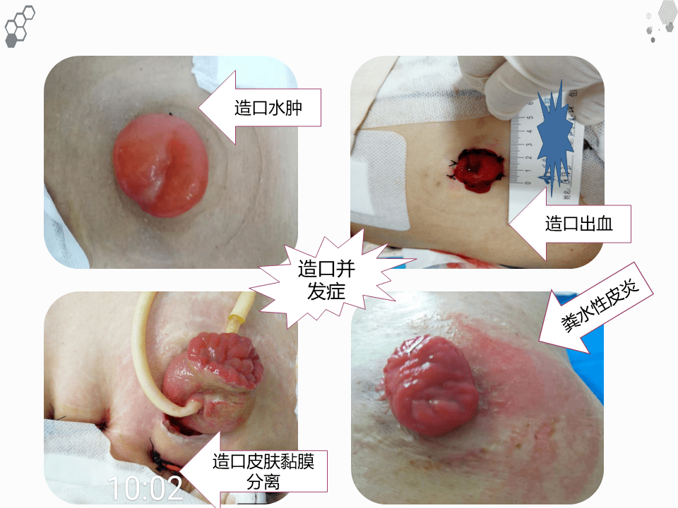 一例结肠癌术后肠造口缺血坏死护理查房