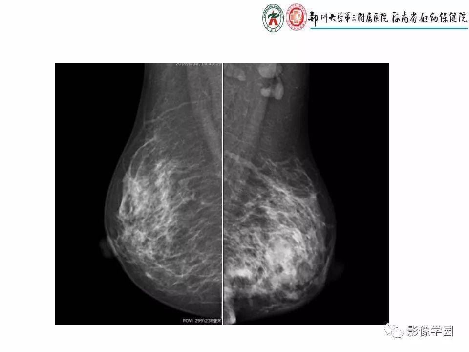 炎性乳癌图片