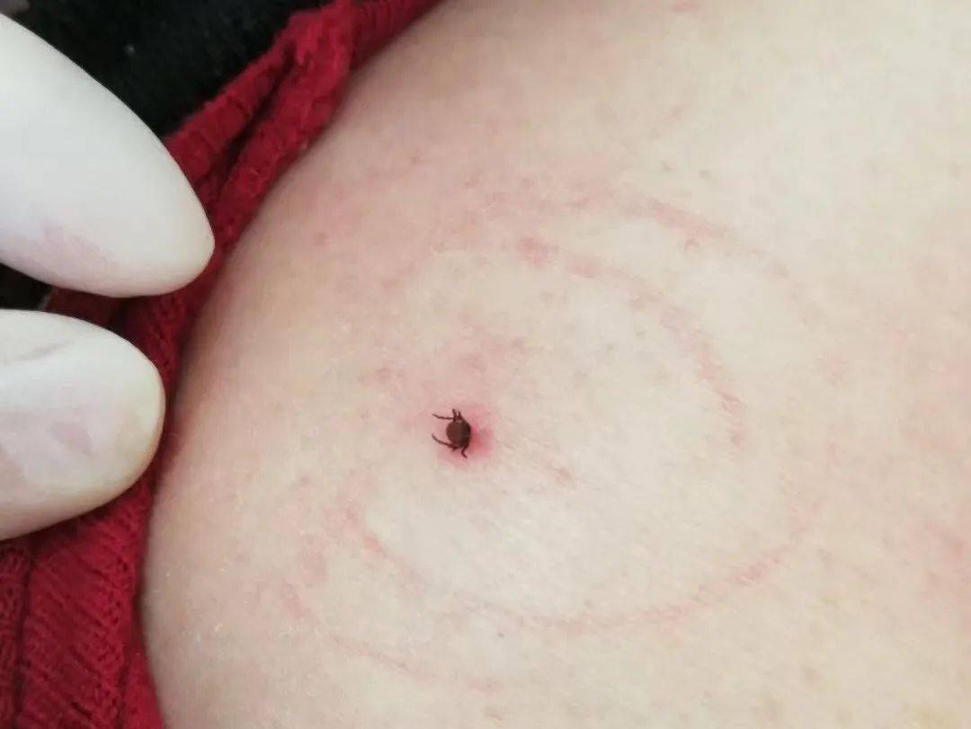 蜱虫的嗅觉很敏锐,当人经过与之接触时,蜱虫便爬到人体皮肤较薄的地方