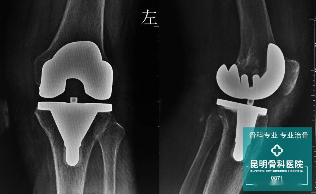 其實,膝關節置換術從目前來講,技術已經非常成熟,在很多三甲醫院或