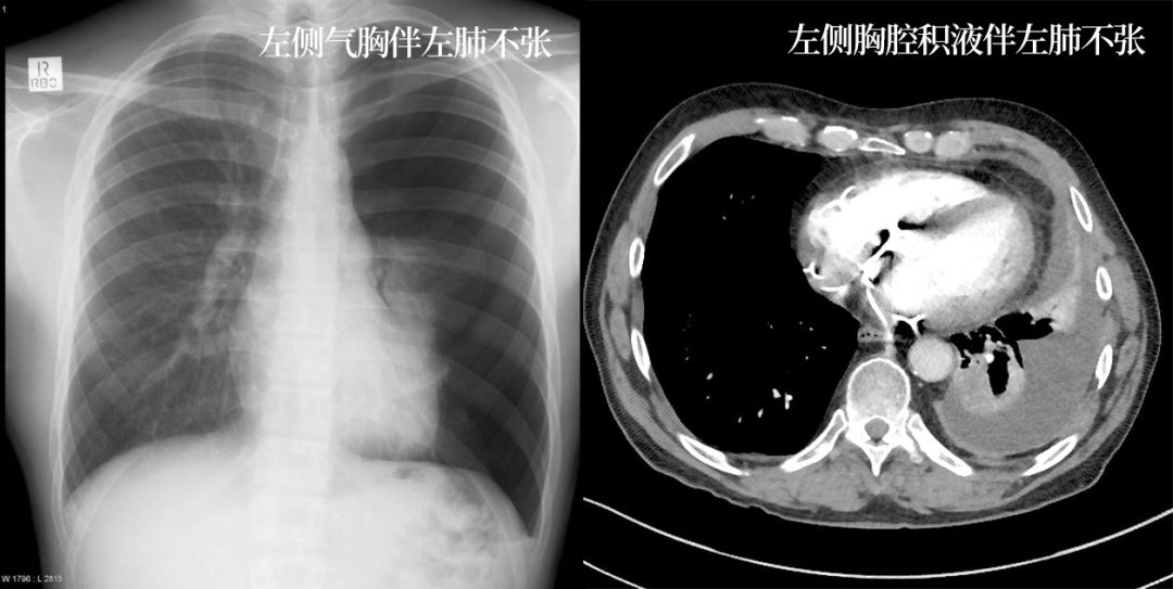 肺不张x线图片